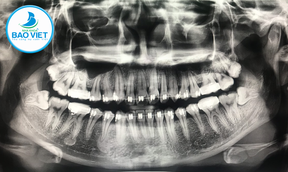 Kết quả chụp CT Cone Beam giúp đánh giá các bệnh lý về răng hàm mặt, cấu trúc xương trên mặt