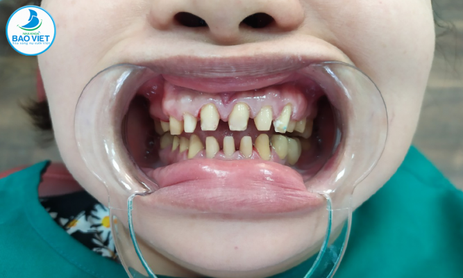 Phương pháp trồng răng bằng cách làm cầu răng sứ trên implant