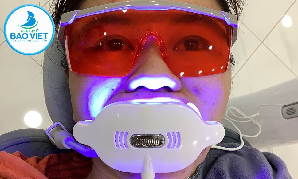 Nha Khoa Bảo Việt là nơi đáng tin cậy được nhiều khách hàng lựa chọn tẩy trắng răng
