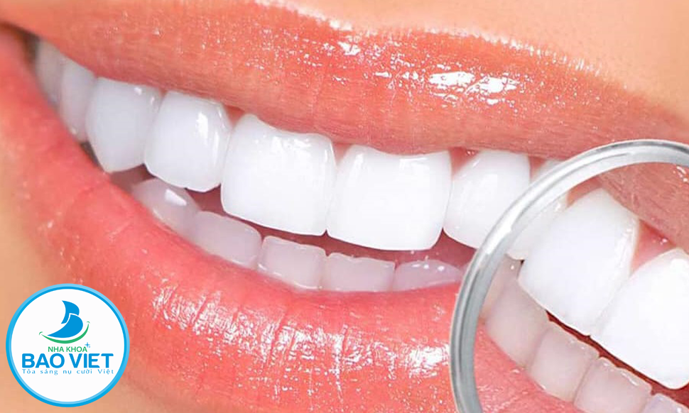 Răng dán Veneer có độ thẩm mỹ và độ bền cao