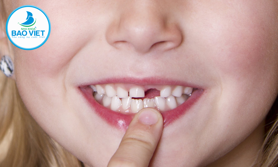 Răng sữa đầu tiên rụng thường là răng cửa giữa