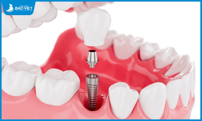 Trồng răng Implant cho trường hợp mất 1 răng