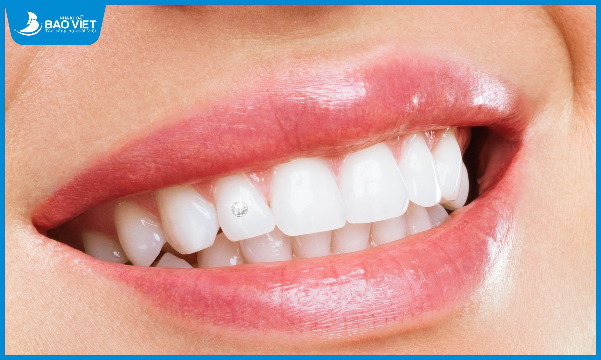 Trường hợp răng đều đẹp, sáng màu, không bị vỡ mẻ đính đá sẽ hiệu quả hơn