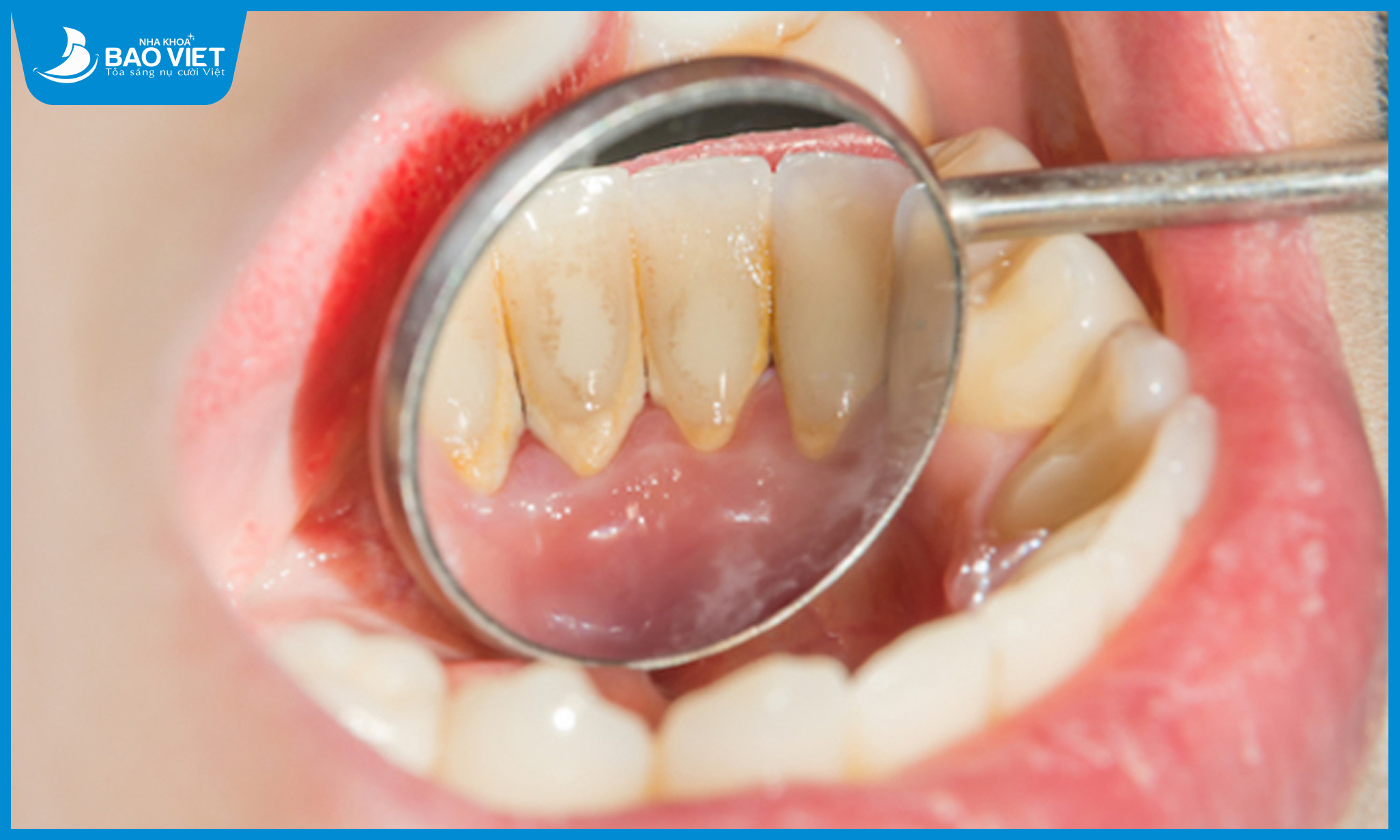 Vôi răng là những mảng bám cứng dính chặt vào bề mặt răng