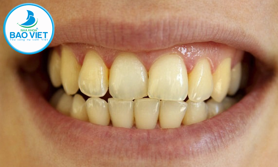 Răng có màu sắc không thẩm mỹ phù hợp dán Veneer