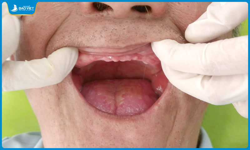 Những người bị mất răng hàm trên hoặc hàm dưới