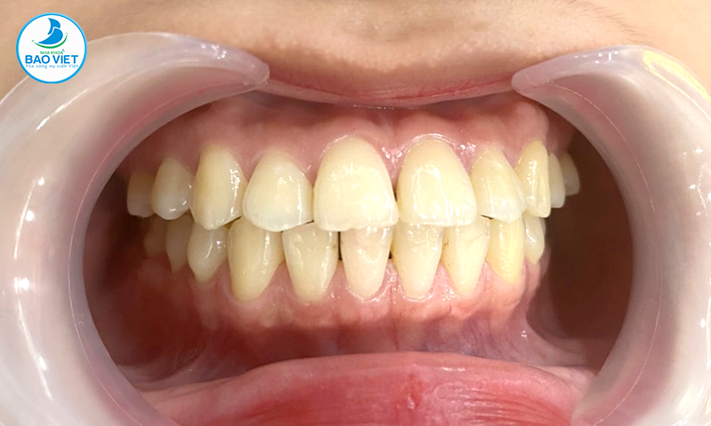 Niềng răng cải thiện hiệu quả tình trạng hô