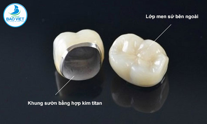 Răng sứ kim loại titan