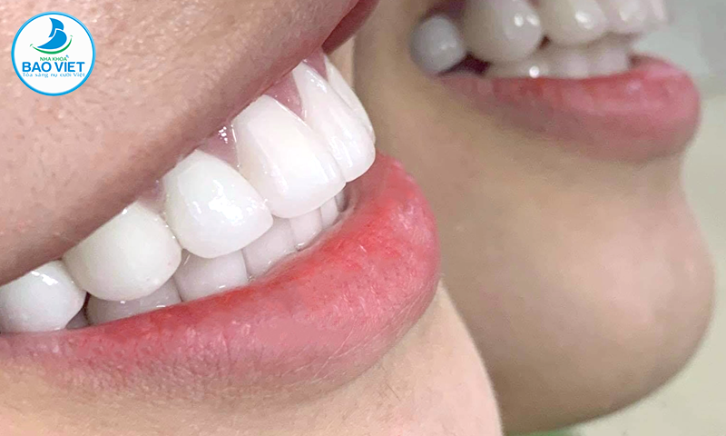 Răng toàn sứ có tuổi thọ trên 10 năm nếu được chăm sóc đúng cách