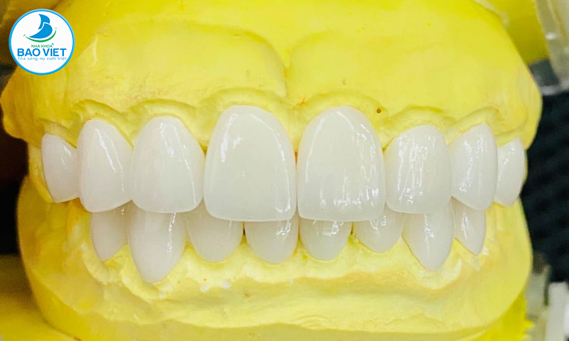 Răng toàn sứ được chế tạo từ 100% sứ nguyên chất