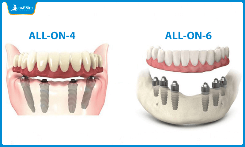 Trồng răng Implant All On 4 – All On 6