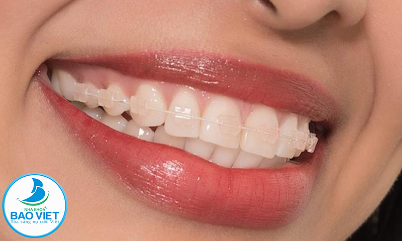 Niềng răng mắc cài pha lê mang tính thẩm mỹ cao do mắc cài có màu trắng trong gần trùng với màu răng