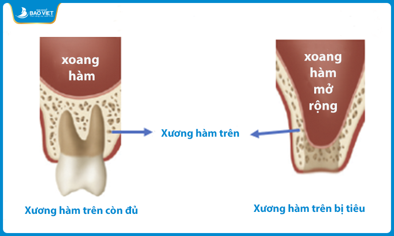 Tình trạng mất răng lâu ngày khiến xoang hàm và xương hàm bi tiêu hủy