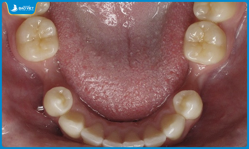 Xương hàm bị tiêu do mất răng lâu ngày