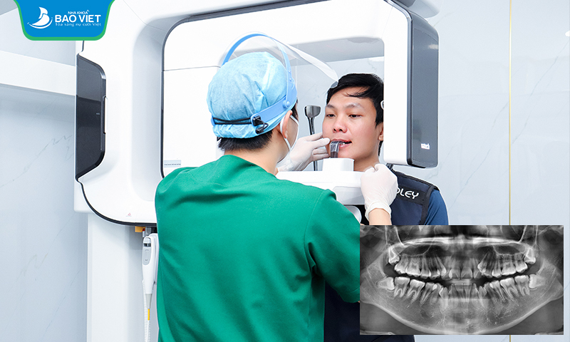 Chụp phim CT cone beam giúp xác định vị trí các răng khôn mọc ngầm phức tạp