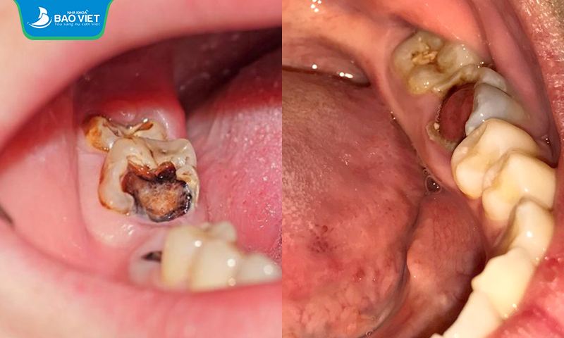 Trường hợp răng hàm bị sâu nặng cần nhổ