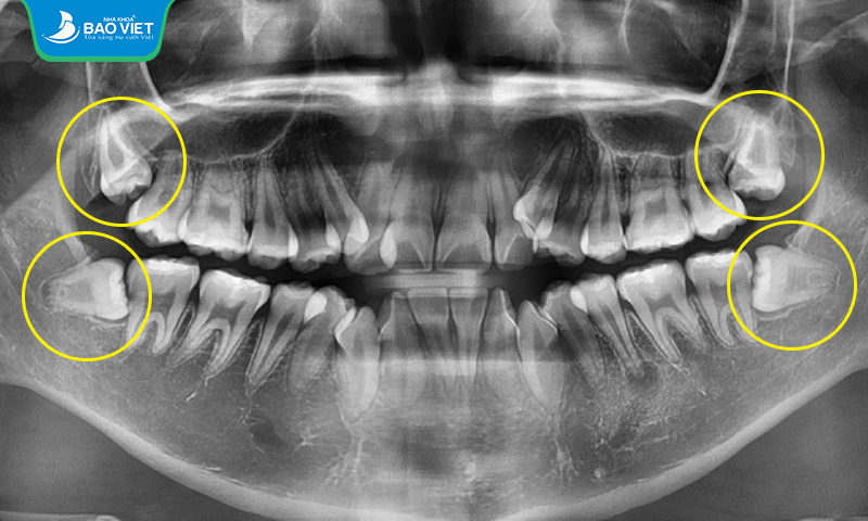 Ở người trưởng thành sẽ mọc 4 chiếc răng khôn vào những vị trí còn trống ở cuối hàm