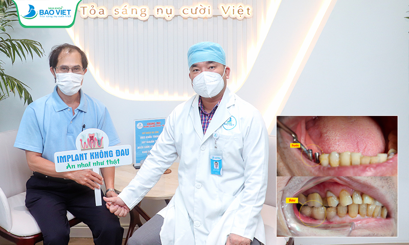 Khách hàng trồng 2 trụ Implant Dentium tại Nha khoa Bảo Việt
