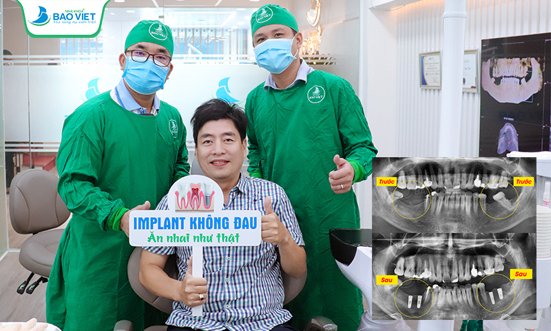 Khách hàng trồng 4 trụ Implant Osstem tại Nha khoa Bảo Việt