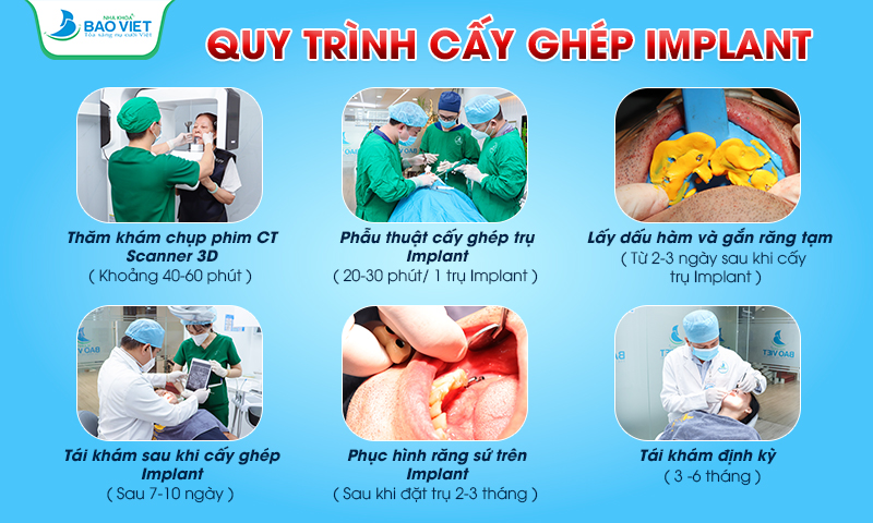 Quy trình trồng răng Implant an toàn hiệu quả tại Nha khoa Bảo Việt