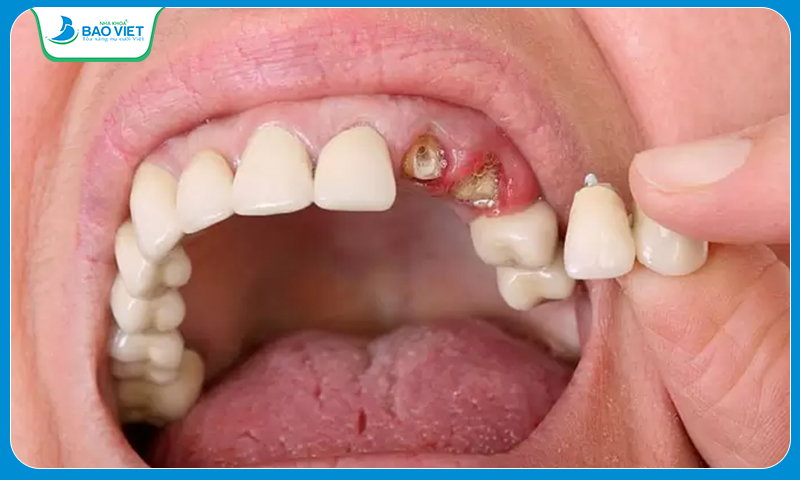 Răng sau khi bọc sứ dễ bị nứt, vỡ
