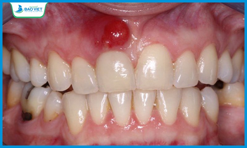Đau nhức răng do áp xe răng