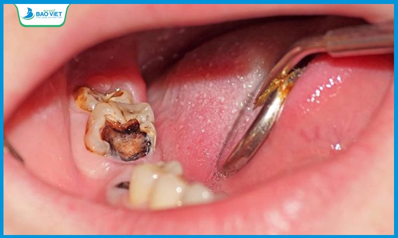 Đau nhức răng do viêm tủy răng