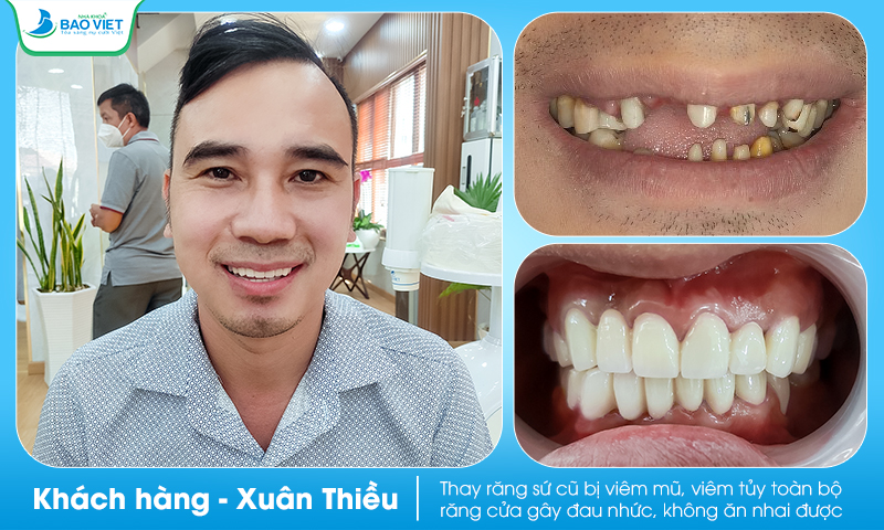 Khách hàng bọc 16 răng toàn sứ Zirconia tại Nha khoa Bảo Việt
