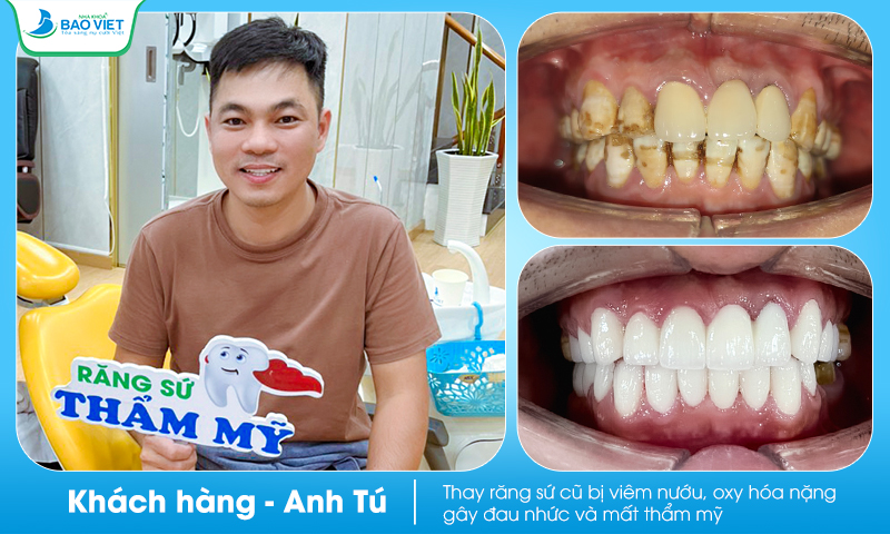 khách hàng bọc răng sứ tại Nha khoa Bảo Việt