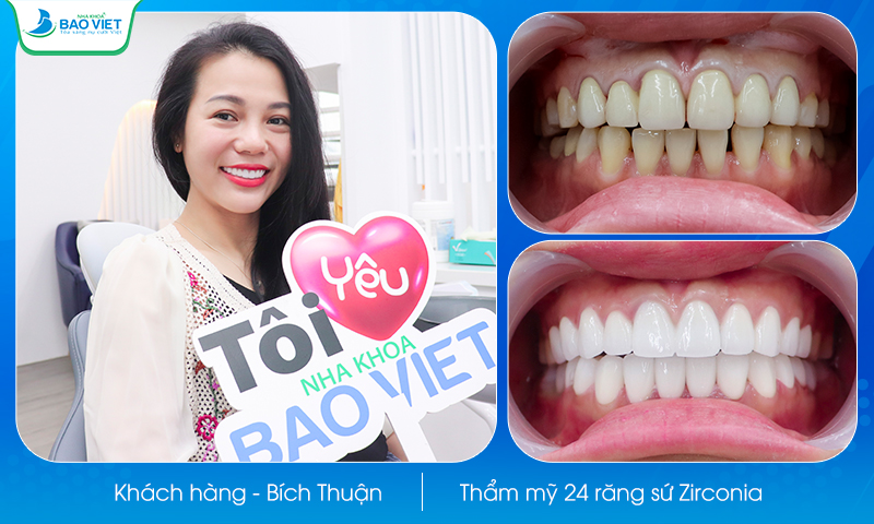 Khách hàng bọc răng sứ tại nha khoa Bảo Việt