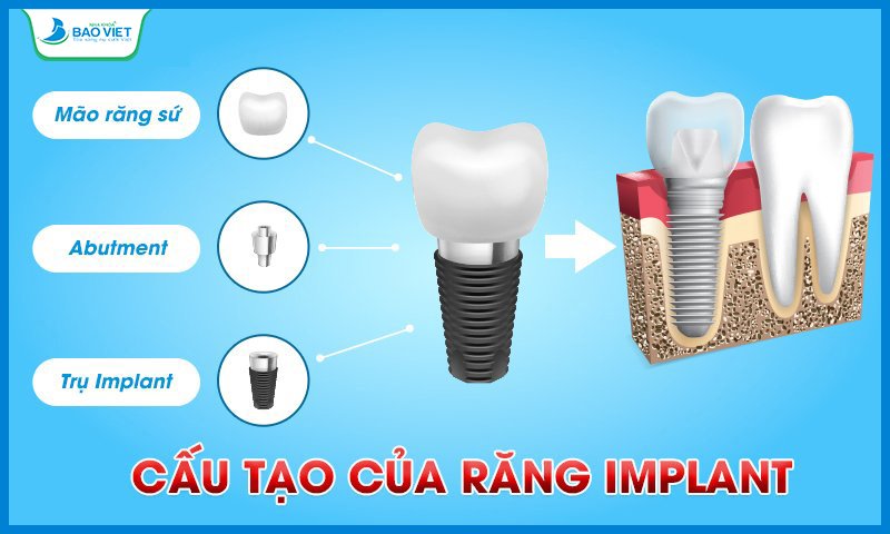 Răng Implant có đầy đủ bộ phận như một chiếc răng thật bao gồm: chân răng, thân răng