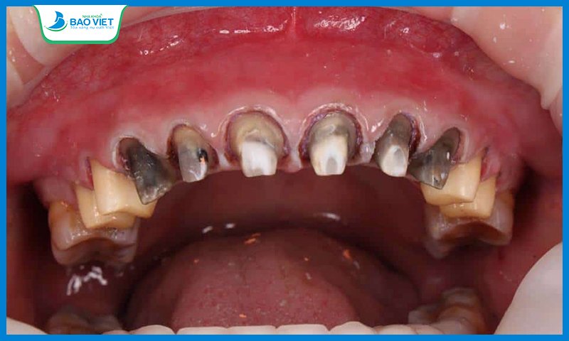 Răng thật bị hư hỏng do bọc răng sứ sai kỹ thuật