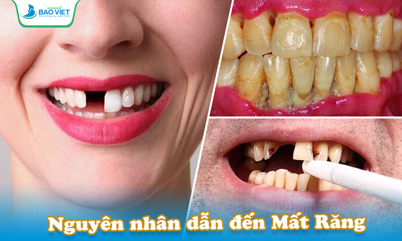 Sâu răng, viêm lợi, viêm nha chu... không điều trị kịp thời dẫn đến tình trạng mất răng