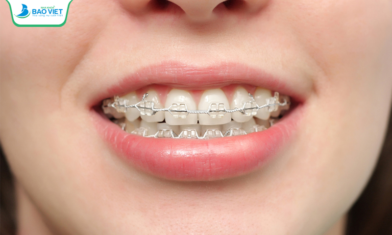 Mắc cài sứ có màu trắng trong rất giống răng thật nên sẽ ít bị lộ niềng hơn mắc cài kim loại