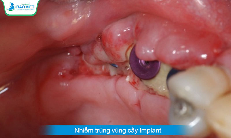 Nhiễm trùng vùng cấy Implant