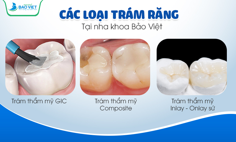 Phương pháp trám răng có 3 loại chính với các vật liệu trám khác nhau