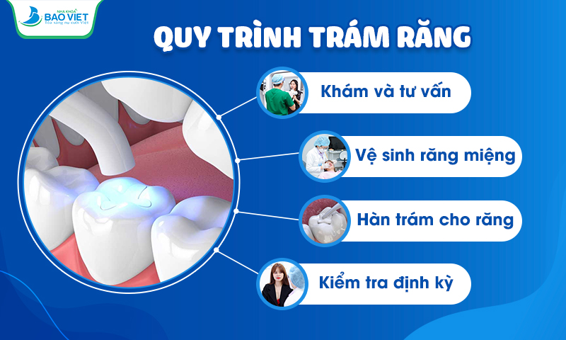 Quy trình trám răng tại nha khoa Bảo Việt