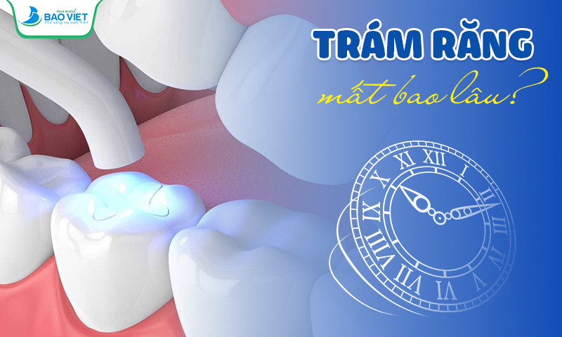 Trám răng mất bao lâu tùy thuộc vào tình trạng răng cụ thể