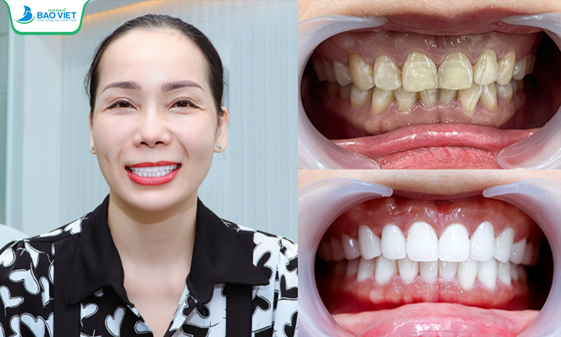 Khách hàng boc 24 răng sứ Zirconia cải trị tình trạng răng nhiễm màu nặng