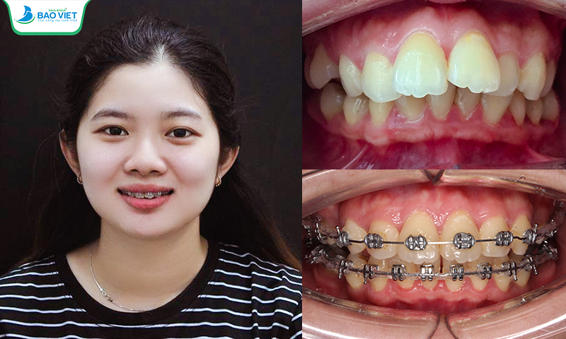 Khách hàng niềng răng điều trị tình trạng răng khấp khểnh